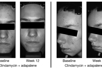 Adding Adapalene Gel to Clindamycin Helps Patients with Acne Vulgaris